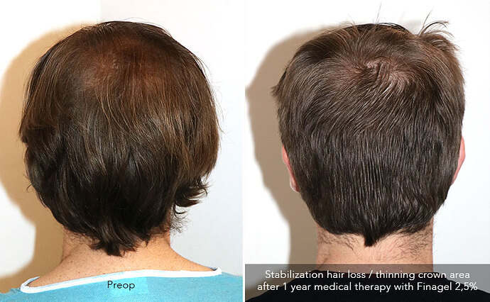 Case performed by Dr. Feriduni – 3322 FU in 1 procedure photo