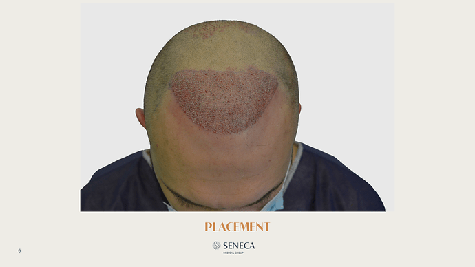 Seneca Medical Group - 1517 grafts with Direct FUE photo