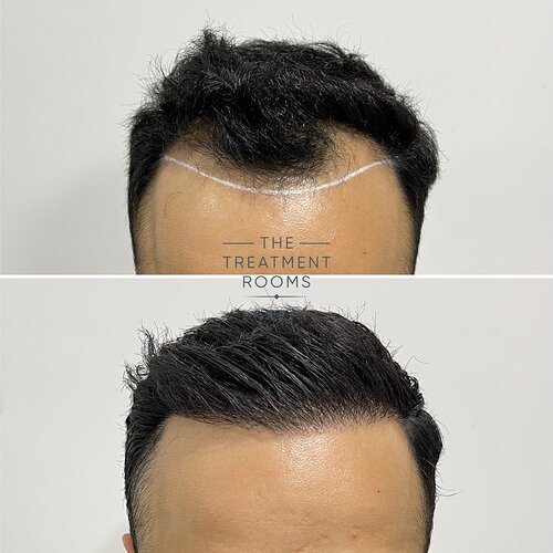 Small 1274 Grafts Hairline Hair Transplant- The Treatment Rooms London photo