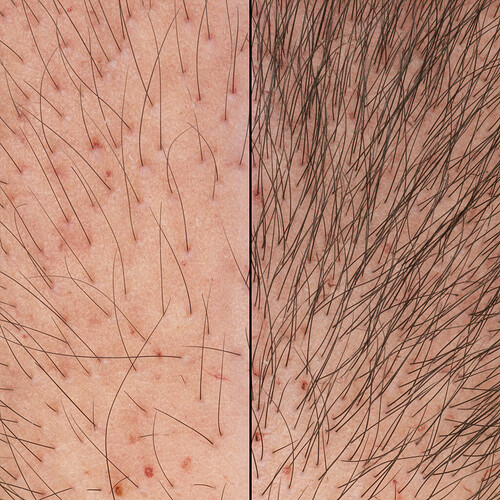 Comparison of sparse versus optimal hair graft density on the scalp.