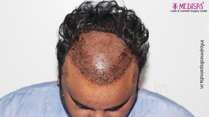 Dr. Suneet Soni - 4500 Grafts, 3 Year Result, NW-IV, Combine FUT + FUE Technique photo