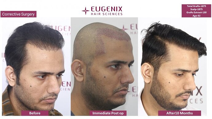Corrective Hair Transplantation | Hairline Correction I 7 months update @Eugenix Hair Sciences photo