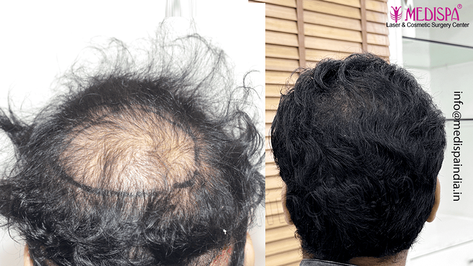 Dr. Suneet Soni - 5467 Grafts, Combine FUT + FUE + Beard Technique, NW- V, 3 Years Result photo