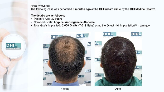 DHI India™ | Crowning Glory Restored | 2,650 Grafts | 8 Months Hair Transplant Result photo