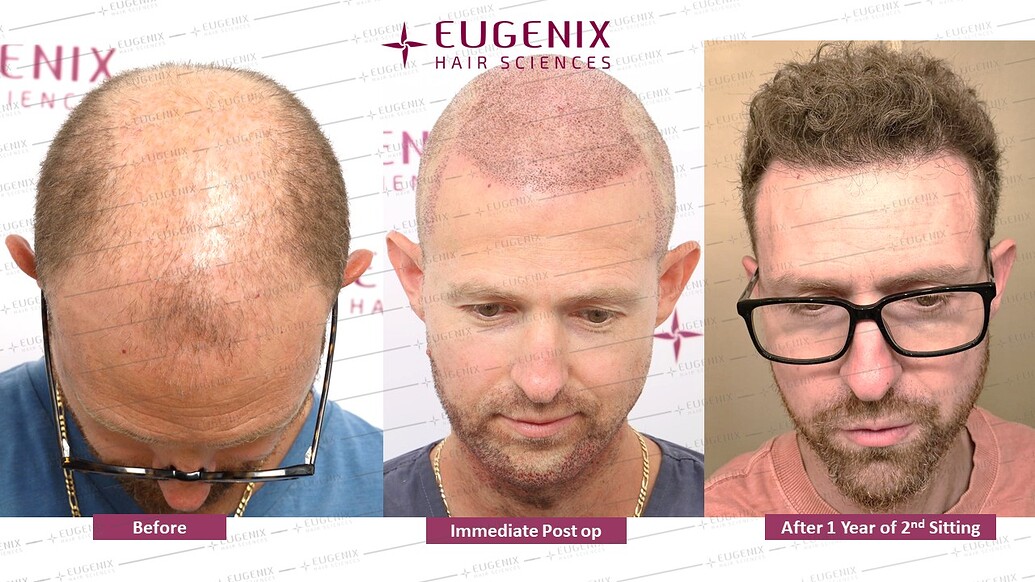 https://cdn.forumhairtransplant.com/optimized/3X/9/4/9474cd5b0f1e1008d79f28e67f193b0074167fee_2_1035x582.jpeg
