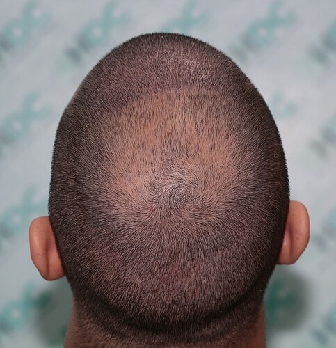 Result of 4000 grafts – 11 months after – NW class 4 photo