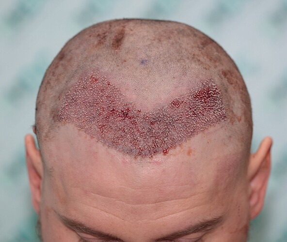 Hairline FUE Result for 2500 Grafts – 8 Months After – HDC Hair Clinic photo
