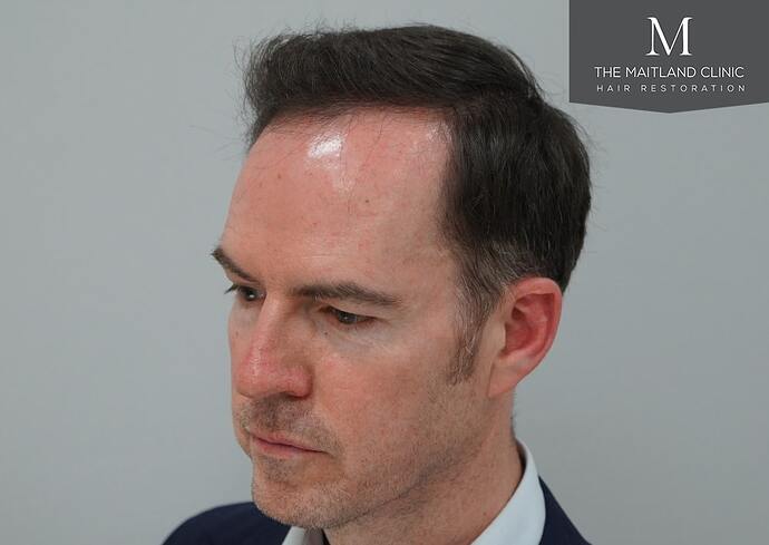 Dr Ball - The Maitland Clinic 1432 Grafts By FUE photo