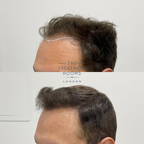 Crown and Hairline 1736 Grafts FUE Hair Transplant Result photo