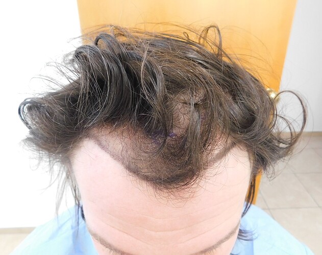 Hairline FUE Result for 2500 Grafts – 8 Months After – HDC Hair Clinic photo