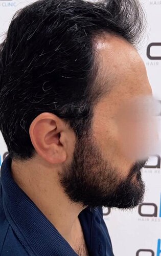 DR HAKAN DOGANAY/ 2000 GRAFTS / Implanter Pen+FUE photo