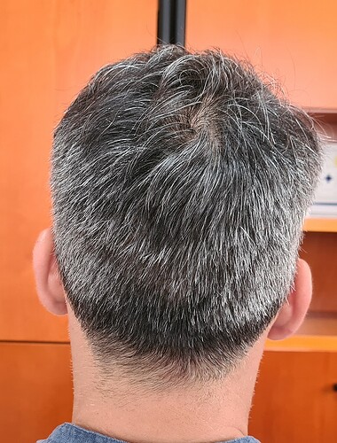 Enhancement of density to top and crown with 2900 Grafts only – HDC Hair Clinic photo