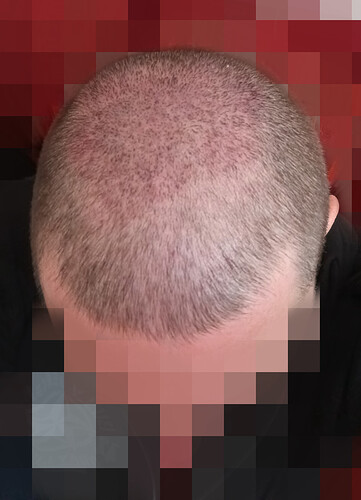 Dr Fares Seffen (Tunis, Tunisia) 2766 FUE results (Midscalps + Vertex) Day 0 --> 07 Months later photo