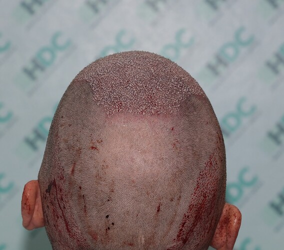 FUE Result for 4400 Grafts – 6 Months after – HDC Hair Clinic photo