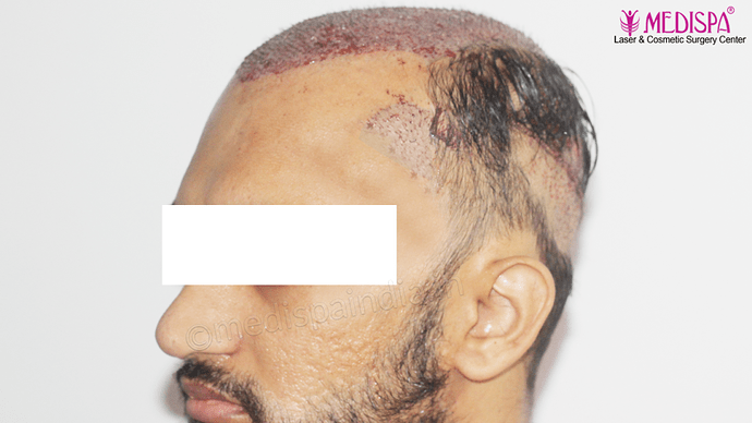 Dr. Suneet Soni - 4665 Grafts, Combine FUT + FUE + BHT (Beard) Technique photo