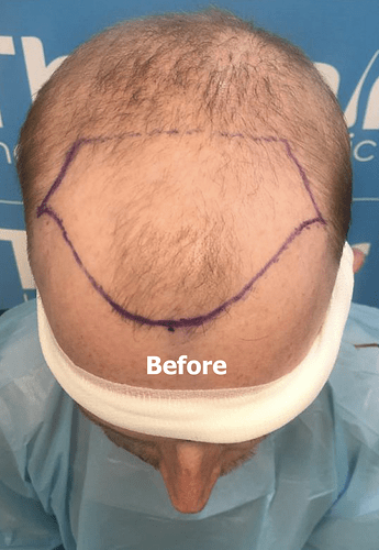 Lee's hair restoration journey - very fine/light hair - Dr Arshad (The Hair Dr Clinic, Leeds, UK) photo