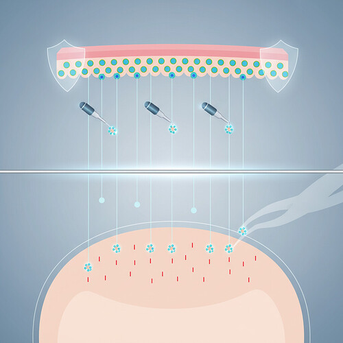 Illustration showing the FUE hair transplantation process: follicle extraction and implantation.