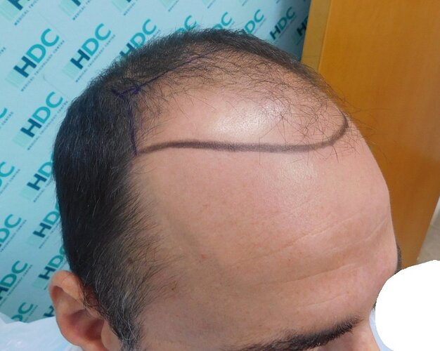 Two FUE Surgeries Totaling 6560 Grafts – HDC Hair Clinic photo