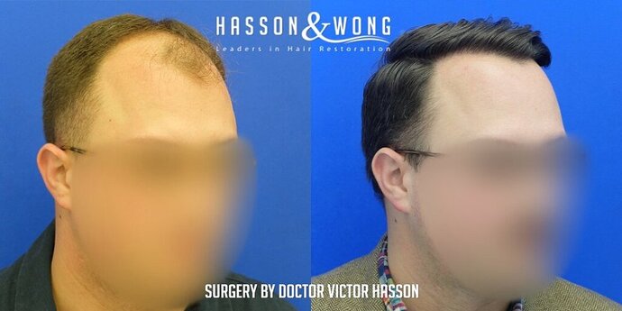 Dr. Hasson / 4,511 grafts / FUE / Frontal zone /mid / 3 years post-op photo