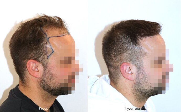 Case performed by Dr. Feriduni – 3726 FU in 1 procedure photo
