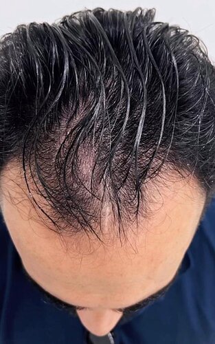 DR HAKAN DOGANAY/ 2000 GRAFTS / Implanter Pen+FUE photo