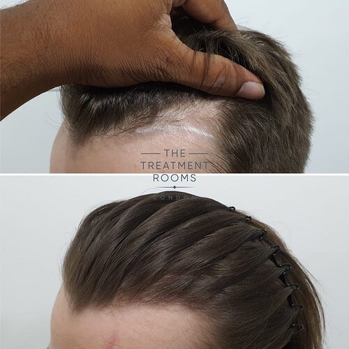 Small temple hair transplant- 600 grafts photo
