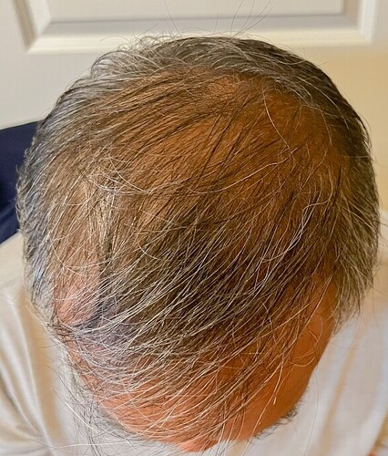 AlviArmani new FUE result 3,500 grafts - Dr. Hughes photo