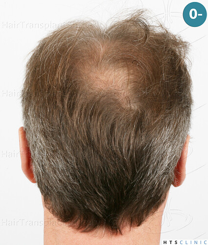 Dr Devroye + Dr Montesanti + Dr Jenard / 7015 grafts (4512 FUT + 2503 FUE) / 2 sessions photo