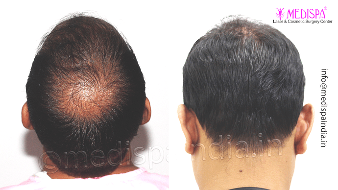 Dr. Suneet Soni - 4533 Grafts, Combine FUT + FUE Technique , NW-IV/V photo