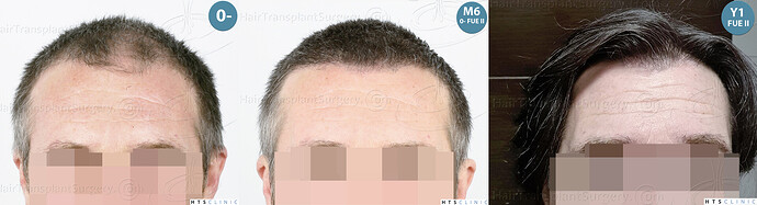 Dr. Jean Devroye, HTS Clinic / 5913 grafts (3036 FUE + 2877 FUE-BHT) / 2 sessions photo