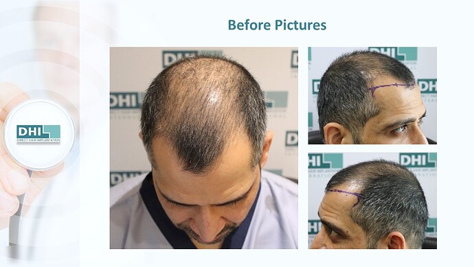 DHI India™ | NW 5 | 2,985 Grafts | 12 Months DHI Hair Transplant Results photo