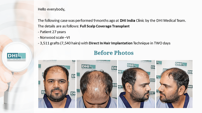 Full Scalp Coverage – 3511 Grafts | DHI India Result photo