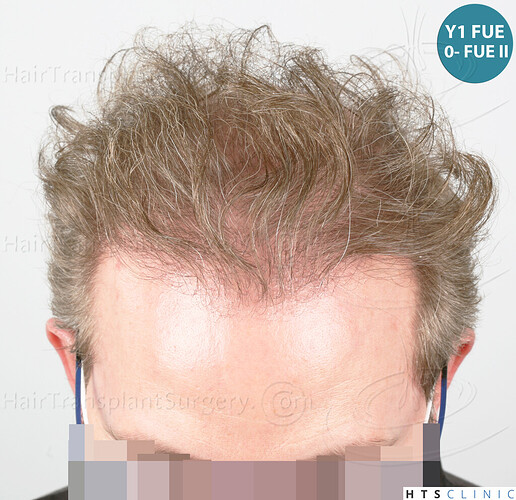 Dr. Jean Devroye, HTS Clinic / 6494 FUE-BHT (3150 + 3344) / NW VII, 2 sessions photo