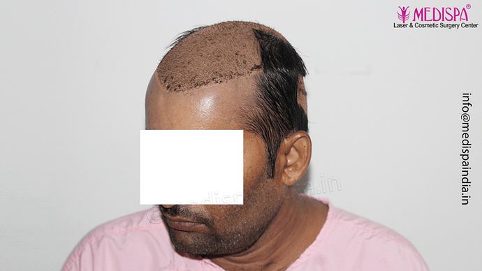 Dr. Suneet Soni - 4992 Grafts | 12-Month Result | Combination FUT + FUE + Beard photo