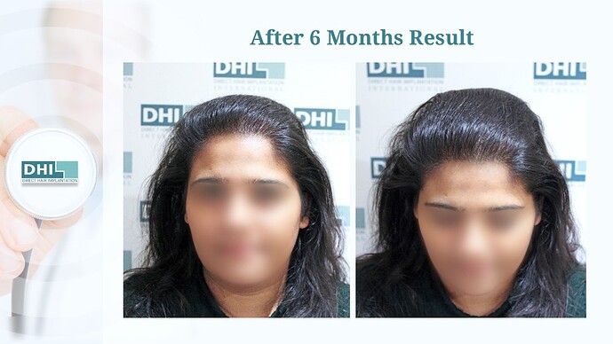 Female Hair Transplant | 1,359 Grafts | 6-Months Result | DHI India™ photo