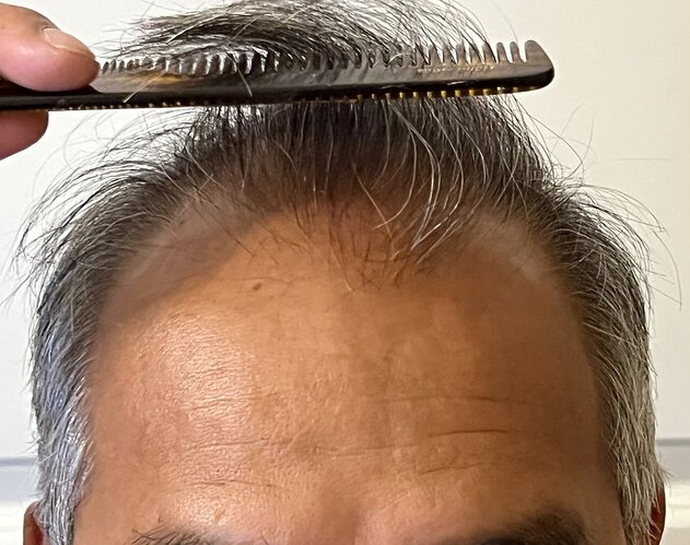 AlviArmani new FUE result 3,500 grafts - Dr. Hughes photo