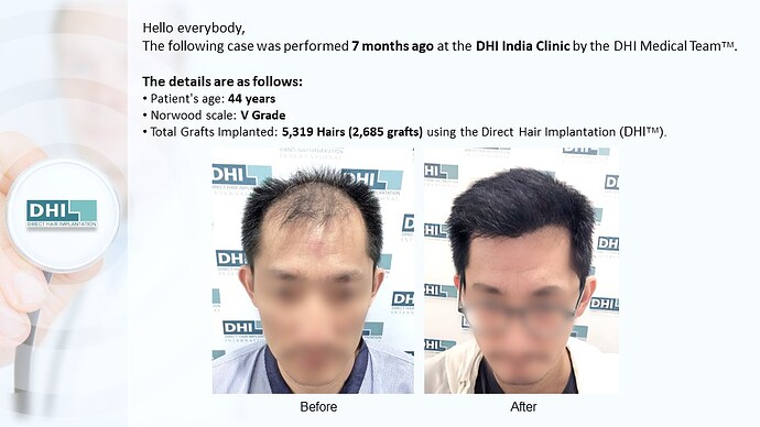 DHI India | NW 5 | 5,319 Grafts | 7-Months DHI Hair Transplant Results photo