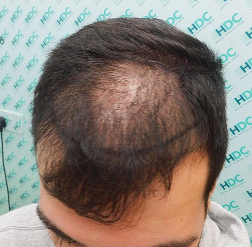 FUE Hair Transplant Result for 3100 Grafts - NW3 – 8 Months After – HDC Hair Clinic photo