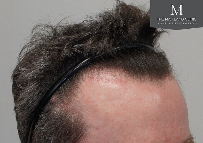 Before and after results: 1694 grafts by FUE at The Maitland Clinic (Dr Edward Maitland Ball) photo
