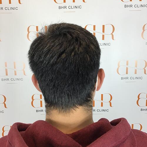 Dr. Bisanga BHR Clinic - 2350 FUE 0 – 12 Months with Photos and Video photo