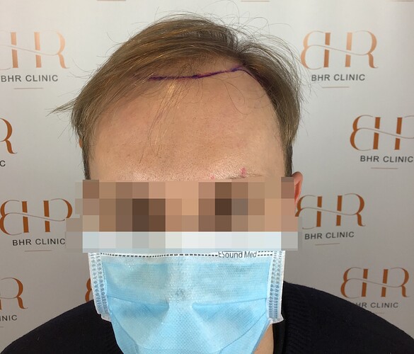 Dr. Bisanga + Dr. Kostis - BHR Clinic - Fine Hair - 2800 Grafts - 0 - 13 Months photo