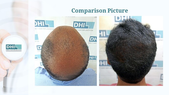 DHI India™ | NW 6 | 4,473 Grafts | 1-Year Hair Transplant Result photo