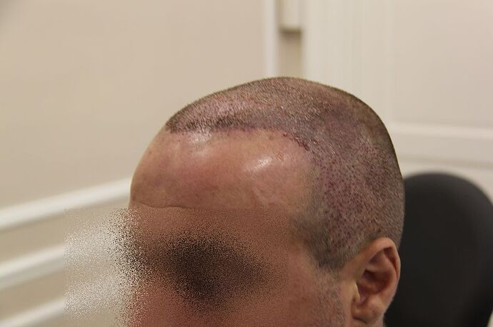 Dr. Bisanga, BHR Clinic, 3344 FUE - 10 Months photo