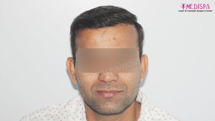 Dr. Suneet Soni - 4025 Grafts | 12-Month Result | Combination FUT + FUE photo