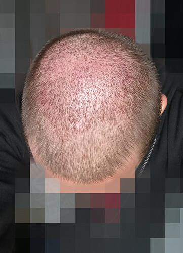 Dr Fares Seffen (Tunis, Tunisia) 2766 FUE results (Midscalps + Vertex) Day 0 --> 07 Months later photo