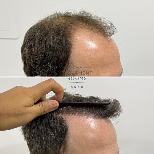 2078 Grafts FUE Hair Transplant Hairline- The Treatment Rooms London photo
