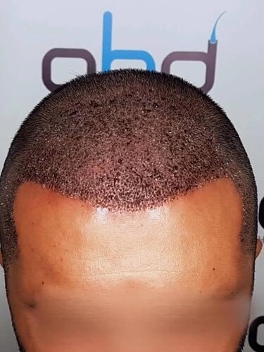 DR HAKAN DOGANAY/ 4500 GRAFTS / Implanter Pen+FUE photo