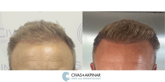 Civas&Akpınar Hair Transplant- FUE Hair Transplant Before & After Pictures (3000 Grafts) photo