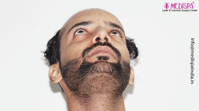 Dr. Suneet Soni - 4046 Grafts | 12-Month Result | Combination FUT + FUE + Beard photo