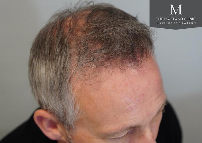 Dr Ball - The Maitland Clinic 2448 Grafts By FUT photo